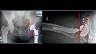 Acetabular Component Position in Total Hip Replacement [upl. by Laius585]