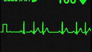 Nodal Trigeminy  ECG Simulator  Arrhythmia Simulator [upl. by Ocirled]