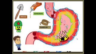 HELICOBACTER PYLORI GASTRITIS [upl. by Laeno762]