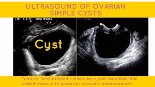 OVARIAN SIMPLE CYST ULTRASOUND REPORT PELVIC ULTRASOUND  ultrasound ultrasoundscans [upl. by Gorrono]