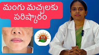 మంగు మచ్చలకు పరిష్కారం  Melasma Treatment  Dr Kanchana Suggestions  KR Herbs Skin Care Clinic [upl. by Esertap]