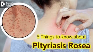 5 Things to know about Pityriasis Rosea  Pityriasis Rosea Rash  Dr Divya SharmaDoctors Circle [upl. by Dunseath]