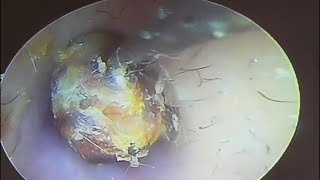 Hard cerumen embolism cleaning earwax Cleaning earwaxremoval satisfying [upl. by Guenna]