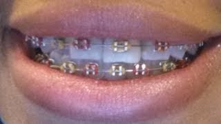 Come along with me to the Orthodontists‎ another rubber band change amp braces update [upl. by France425]