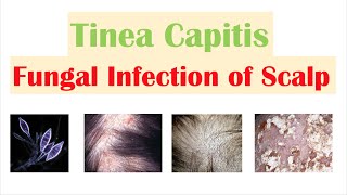 Fungal Infection of the Scalp Tinea Capitis  Causes Risk Factors Symptoms Diagnosis Treatment [upl. by Theo322]