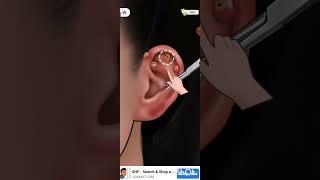 Asmr Ear Cleaning amp treatment [upl. by Tomas688]