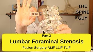 Lumbar Foraminal Stenosis  Fusion Surgery Options Part 2 [upl. by Tak]