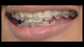 braces time lapse orthodontic treatment [upl. by Robbins]