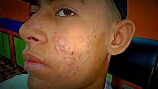 sac be spa blackheads elderly 2024  sac be spa boy age blackheads acne  sac be spa face today 210 [upl. by Laehpar]