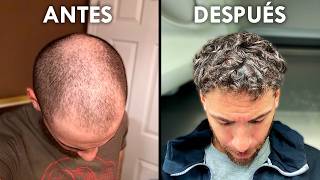 ¿El Secreto Para Recuperar El Pelo Sin Finasteride Oral [upl. by Diarmid1]