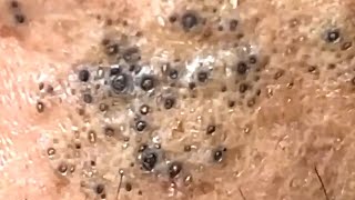 Blackheads Satisfying Removal 0003 [upl. by Llerrit]