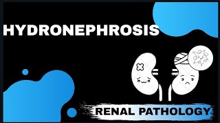 HYDRONEPHROSIS  Renal pathology   Med Bees [upl. by Tlevesor]