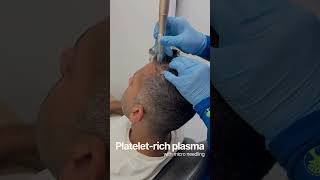 Discover how Platelet Rich Plasma🌱 PRP can boost your hair prp plasma plateletrichplasma [upl. by Jez868]