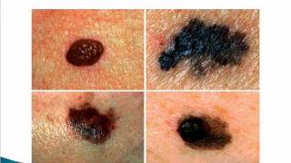 Cancerous moles and warts [upl. by Neehsuan]