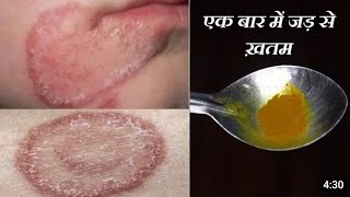 fungal infection  treatment for fungal infection  skin infection treatment  itching treatment [upl. by Merkle]