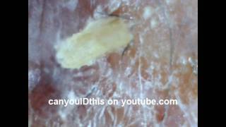 ID THIS SKIN INFECTION PARASITE NEMATODE FUNGUS MRSA BACTERIAL [upl. by Atoiganap]