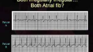 Intro EKG Interpretation Part 3 [upl. by Yroj]