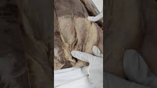 Dissection of Inguinal canal [upl. by Zalucki142]