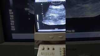 Bilateral nephrolithiasis with Right moderate Hydronephrosis by medical radiology [upl. by Meda]