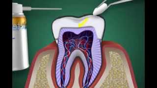 was ist eine Zahnnerventzündung  Pulpitis [upl. by Saxela]
