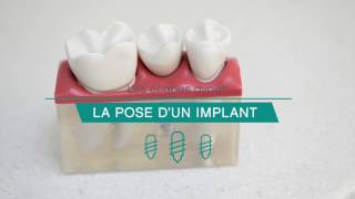 Tout savoir sur la pose dimplant [upl. by Euqinu]