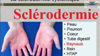 Sclerodermie systémique Symptomes et Pronostic [upl. by Garland]