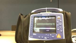 Synchronized Cardioversion with Propaq MD [upl. by Kimberly]