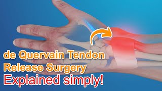 De Quervain Tendon Release Surgery  Explained [upl. by Jammal118]