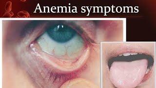 Anemia symptoms [upl. by Lepine436]