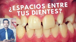 Cómo cerrar los espacios entre los dientes Diastemas dentales [upl. by Lertram473]