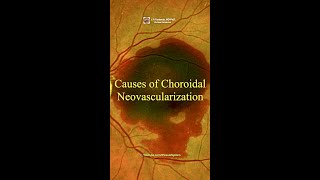 Causes of Choroidal Neovascularization maculardegeneration [upl. by Kjersti]