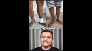 Varicose Veins EXPERT Shares Top Care Secrets After Treatment GUJARATI [upl. by Haleehs]