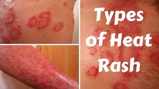 Types of Heat Rash [upl. by Iaverne]