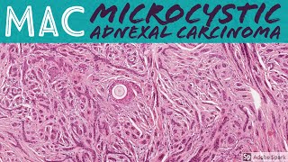 Microcystic Adnexal Carcinoma MAC 5Minute Pathology Pearls [upl. by Ruby]