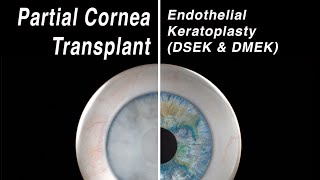 Selective Cornea Transplant  Endothelial Keratoplasty DMEK DSEK [upl. by Farra]