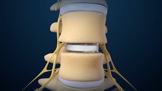 Back Surgery Lumbar Disc Replacement [upl. by Thury]