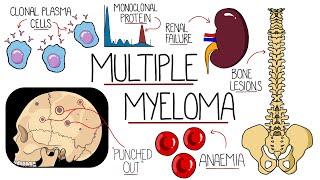 Understanding Multiple Myeloma Multiple Myeloma Explained Clearly [upl. by Lowrie900]