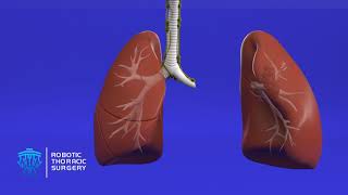 What Do I Need to Know About Lung Resection [upl. by Nav]