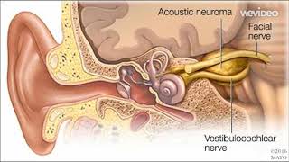 Acoustic neuroma Vestibular schwannoma [upl. by Xella175]