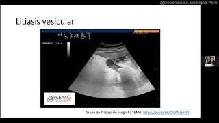 Colecistitis aguda criterios de Tokio y ecografía [upl. by Yenitirb313]