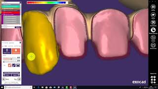 Video7 CADCAM Workflow veneering the YunMed PEEK framework with single zirconia crowns [upl. by Ellasal307]