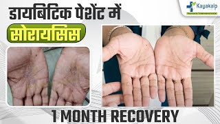 Diabetes में Psoriasis का इलाज कैसे होगा  Psoriasis Recovery in 1 Month Psoriasis Treatment India [upl. by Hoxsie]