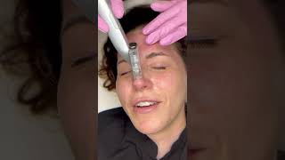 Microneedling with eclipse micro pen evo [upl. by Rhyner]