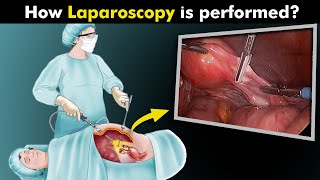 What Happens During Laparoscopy Procedure UrduHindi [upl. by Ecneitap876]