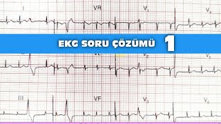 EKG Soru Çözümü1  Ventriküler Erken Vuru•Sinüs ritmi  EKG Örnekleri [upl. by Taimi]