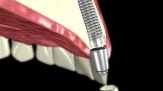 3D Medical Animation of a Dental Implant [upl. by Compton]