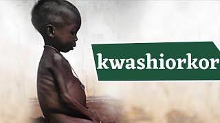 Kwashiorkor Disease What Causes Kwashiorkor जानिये क्वाशियोरकर रोग क्या है इसके लक्षण व उपाय [upl. by Margret785]