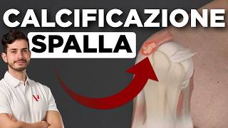 CALCIFICAZIONE SPALLA cosa fare per guarire [upl. by Stanly]