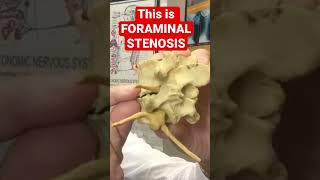 What FORAMINAL STENOSIS Really Looks Like Must See  Dr Walter Salubro [upl. by Assili968]