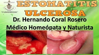 ESTOMATITIS ULCEROSA  INFLAMACIÓN DE LA MUCOSA ORAL [upl. by Ycnaffit]